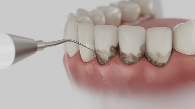 Trusted Wisdom Tooth Removal service in Surfside, FL - Dentist Open Now